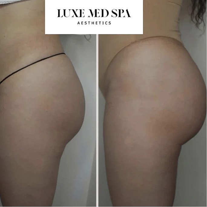 Before and after body contouring treatment comparison.